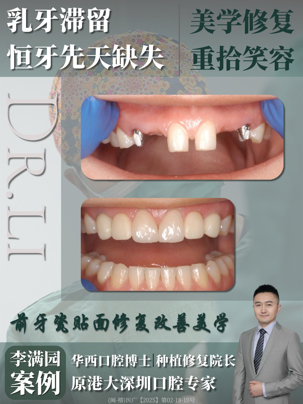 种植牙案例