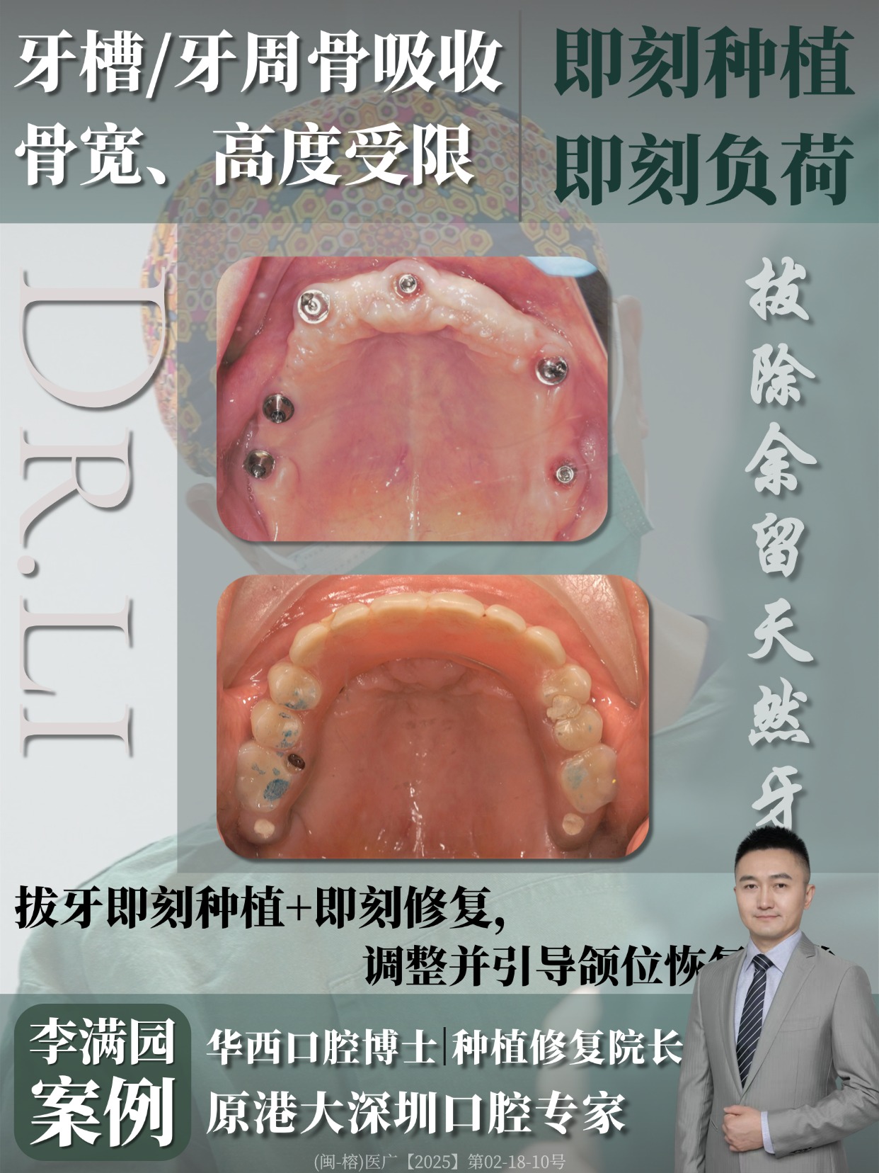 种植牙案例